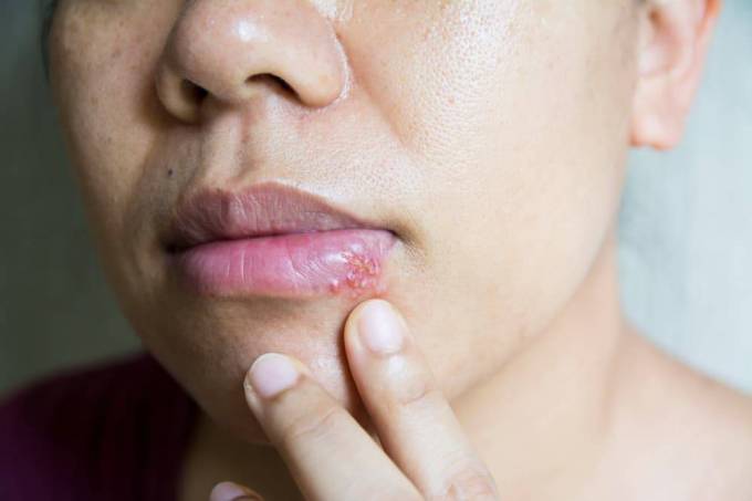 A Successful Valtrex Therapy for Herpes Infections
