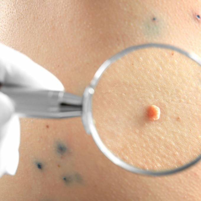 How to Choose the Right Method for Mole Removal?