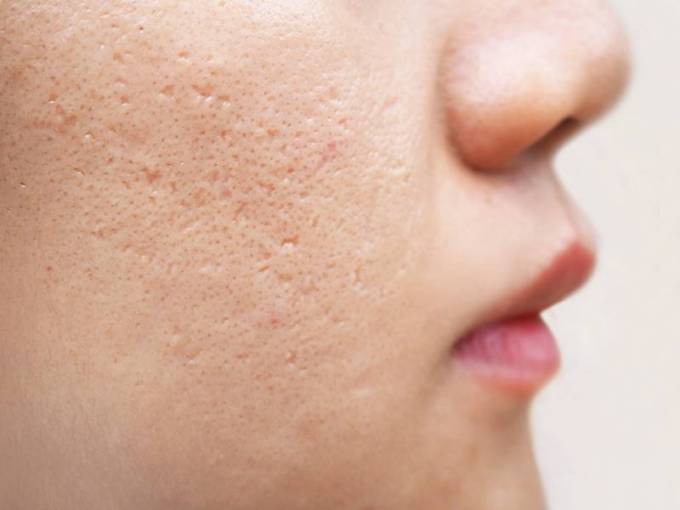 Does laser acne treatjavascript:;ment work on acne scars?