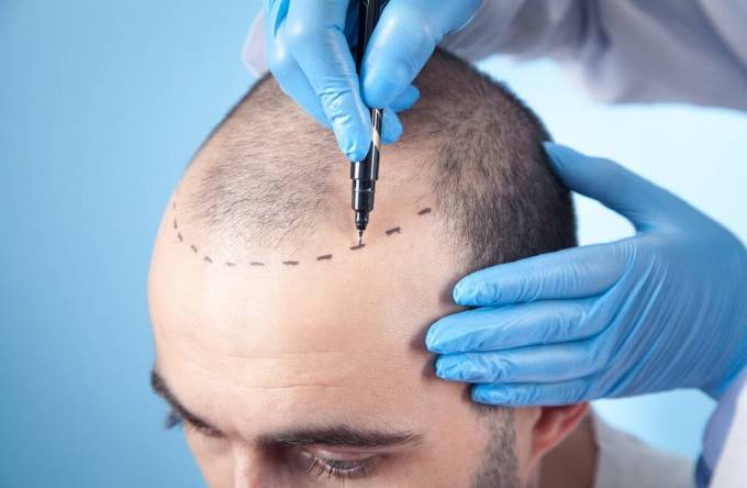 How Does Hair Transplant Impact Self-Image?