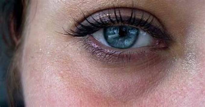 How Can Dark Circles Treatment Help You?