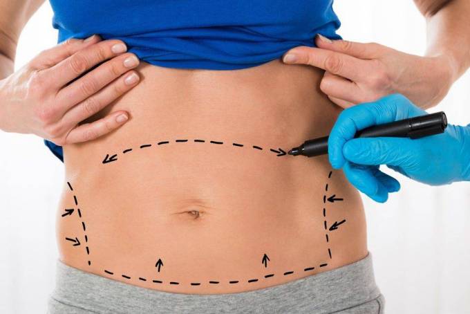 How Does a Scarless Tummy Tuck Work?