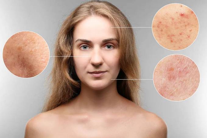 How Effective is Scarless Acne Treatment?