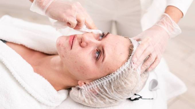 What Makes Scarless Acne Treatment Unique?