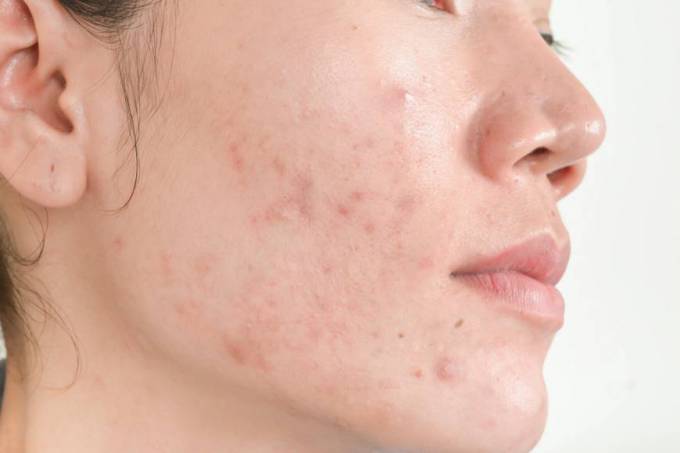 What Are Best Options for Acne Scar Treatment?
