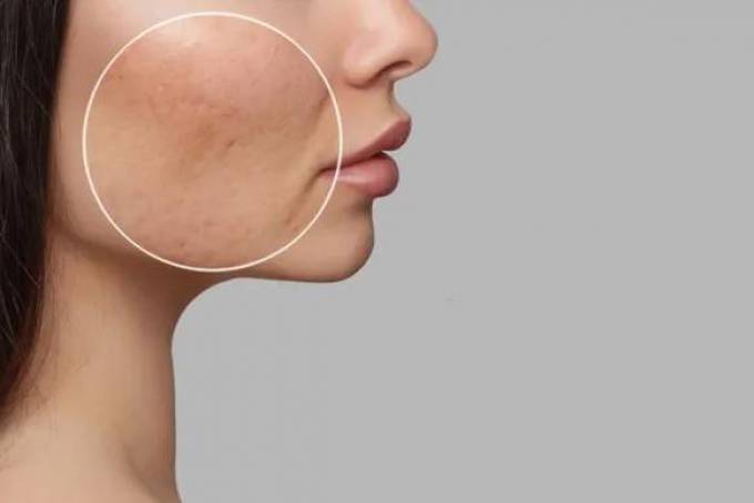 What Is the Best Acne Scar Treatment?
