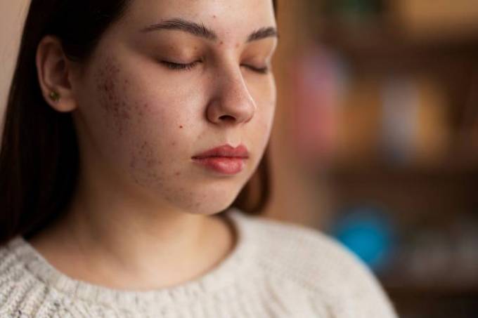 How Effective Is Acne Scar Treatment Today?