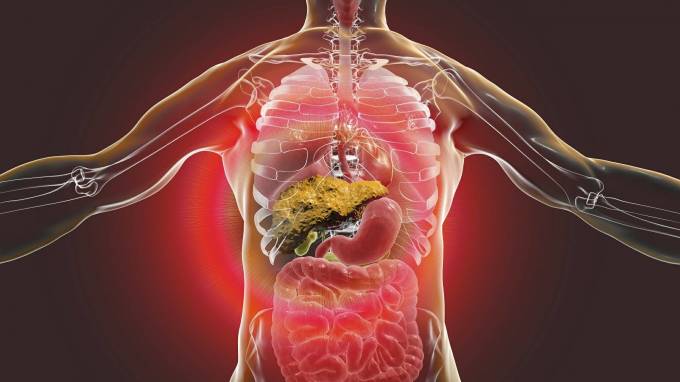 How Does Liver Cirrhosis Affect Daily Life?