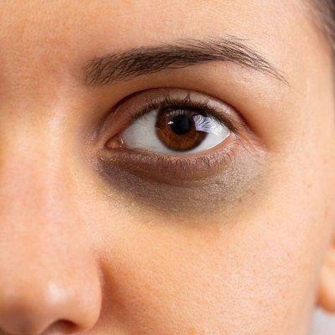 How Effective is Dark Circles Treatment Today?