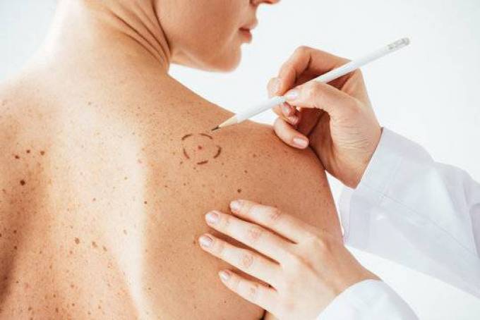 Can laser treatment remove birthmarks?