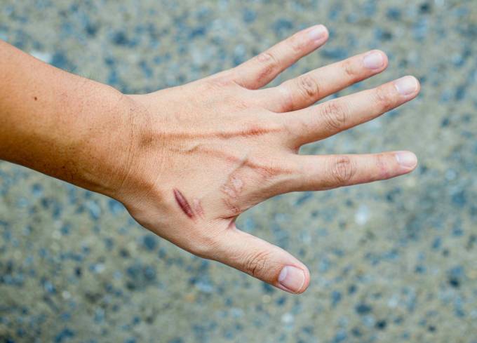 Can scars be removed by surgery?