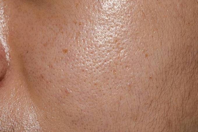Can You Treat Large Pores Without Surgery?