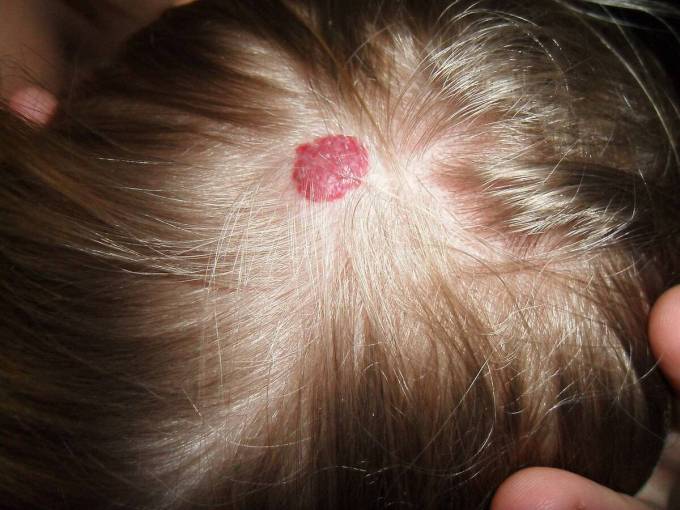 Does Hemangiomas Treatment Work Permanently?