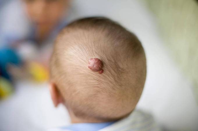 Is Laser Treatment Permanent for Hemangiomas?
