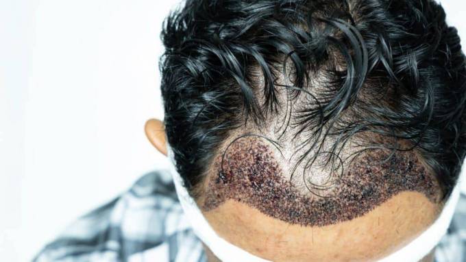 Is Summer Weather Good for a Hair Transplant?
