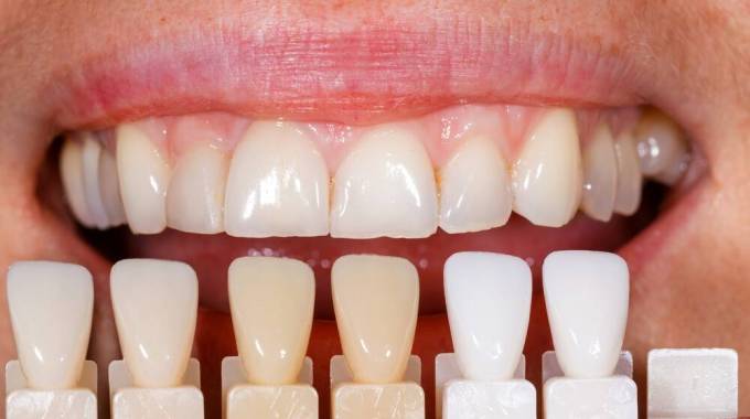 Is Composite Veneers a Permanent Solution?