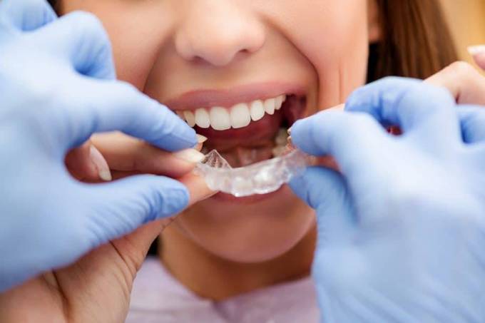 Is Invisalign Suitable for Severe Teeth Misalignment?