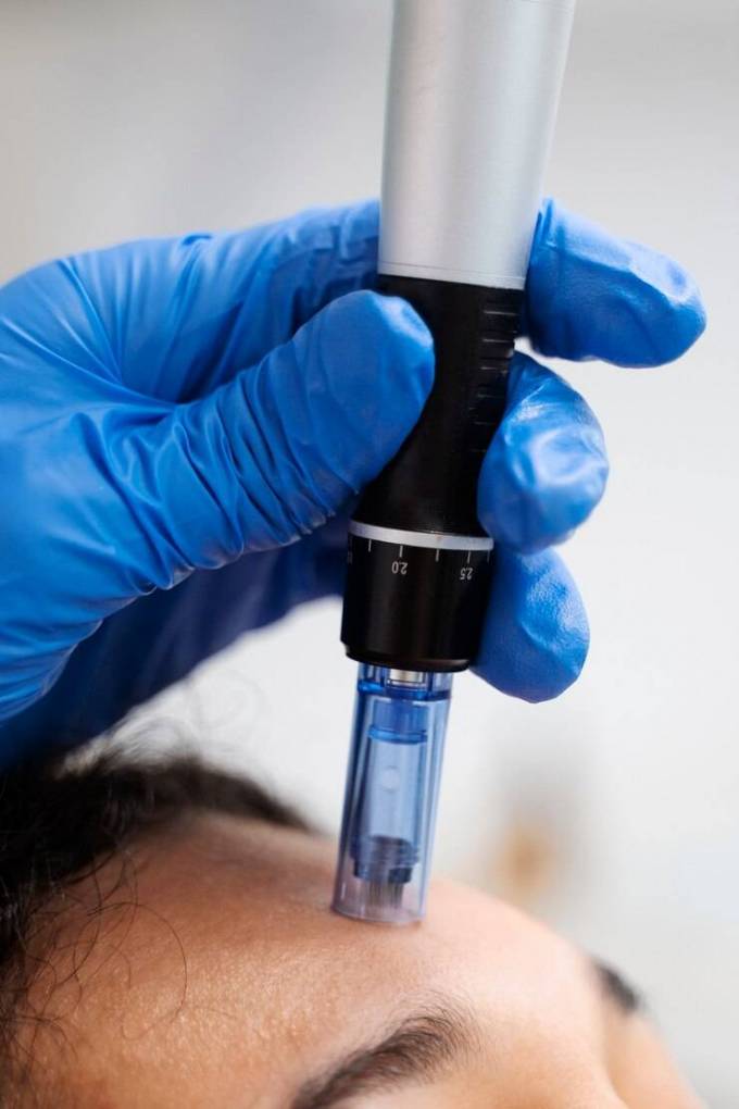 Can Dermamelan Treatment Help with Acne Scars?