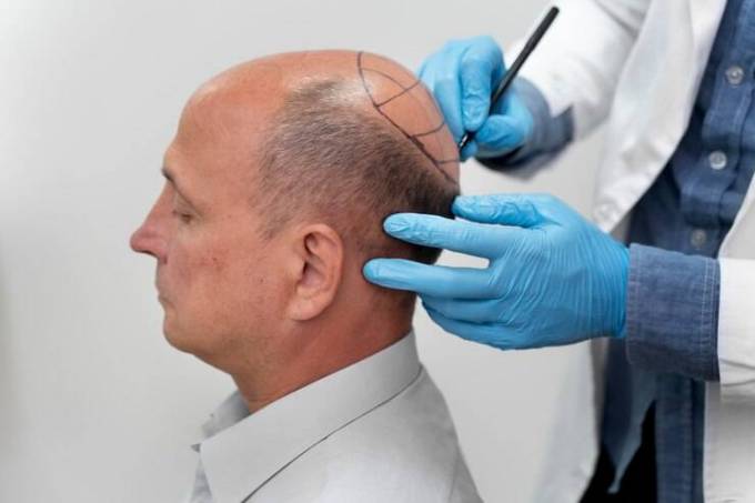 How to Apply Hair Filler for Baldness?