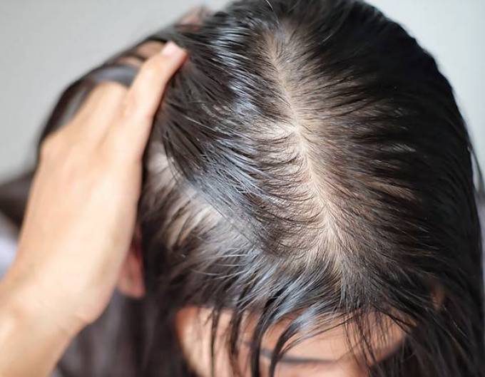 Is Finasteride FDA-Approved for Hair Loss?