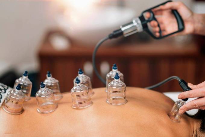 Does Hijama Wet Cupping Therapy Treat Stress Relief?