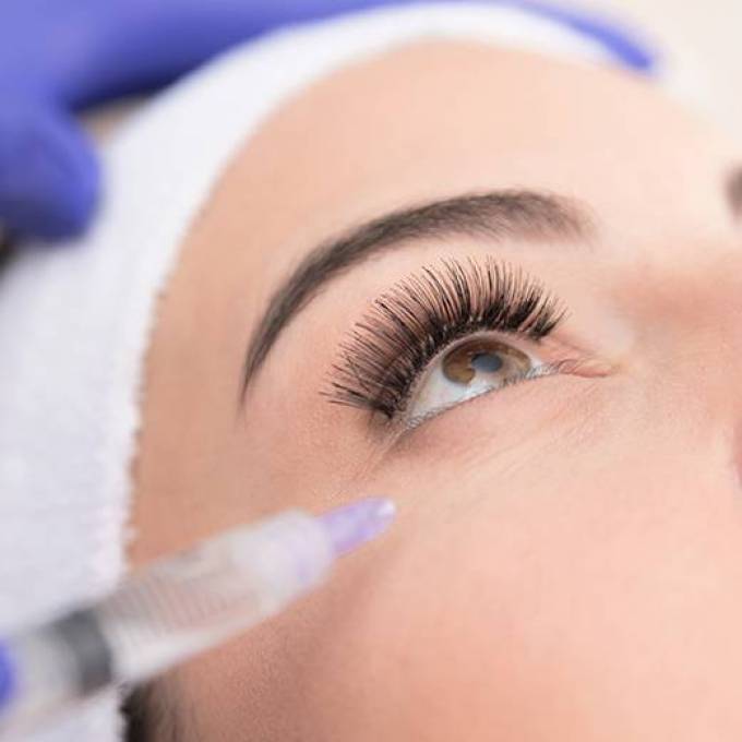 Is Filler Migration Common Under the Eyes?