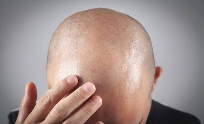 How to Save on Hair Transplant Cost?