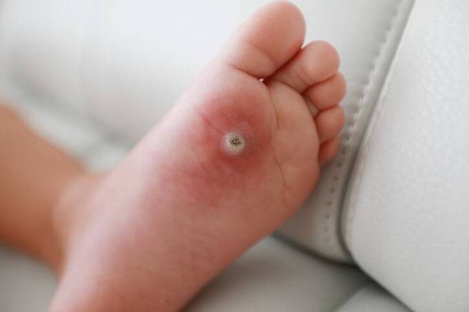 How Painful Is Laser Wart Removal Really?