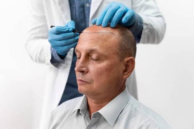 Can Hair Transplant Fix Baldness?