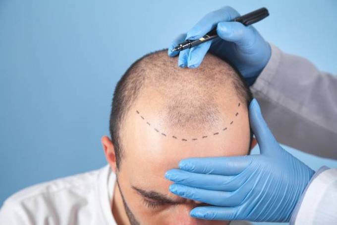 What Is the Success Rate of Hair Transplant?