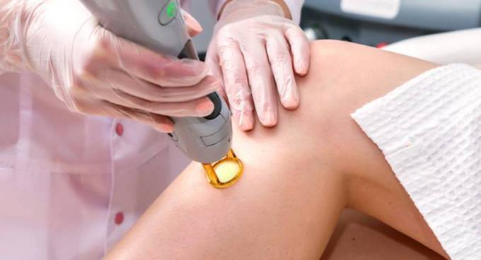 Is Laser Hair Removal Worth It for Skin Beauty?