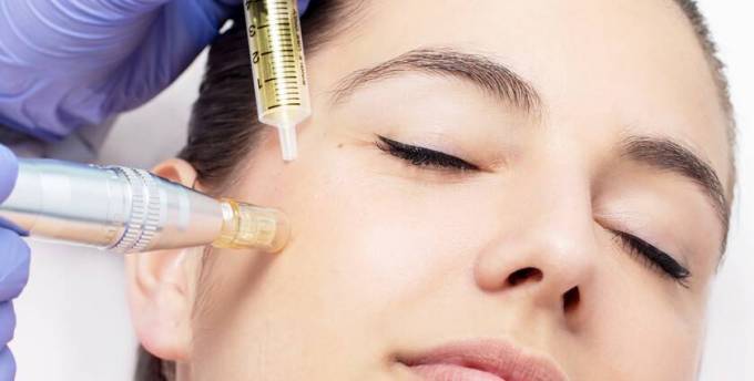 Does Mesotherapy Cost Impact Your Routine?