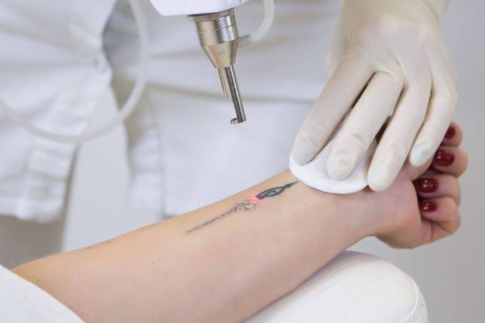 What’s the Cost of Laser Tattoo Removal?