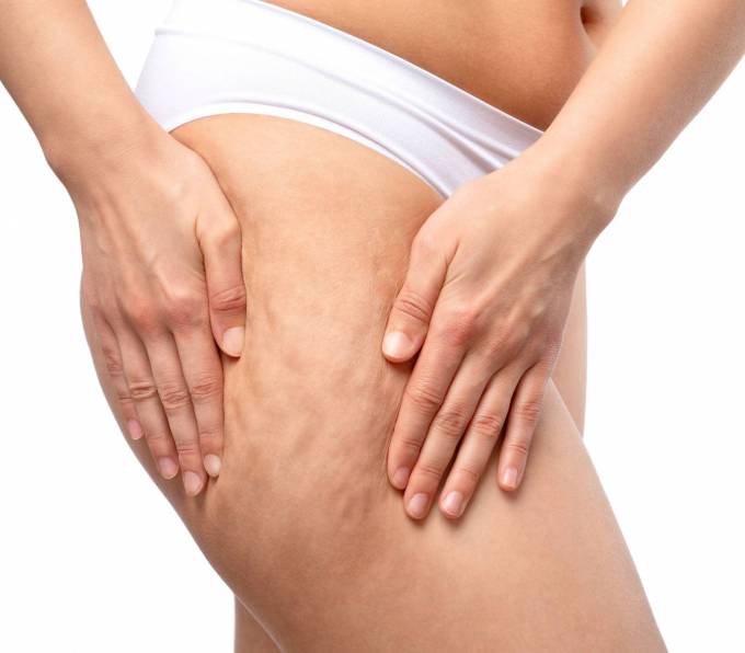 Does Cellulite Treatment Work for Older Skin?