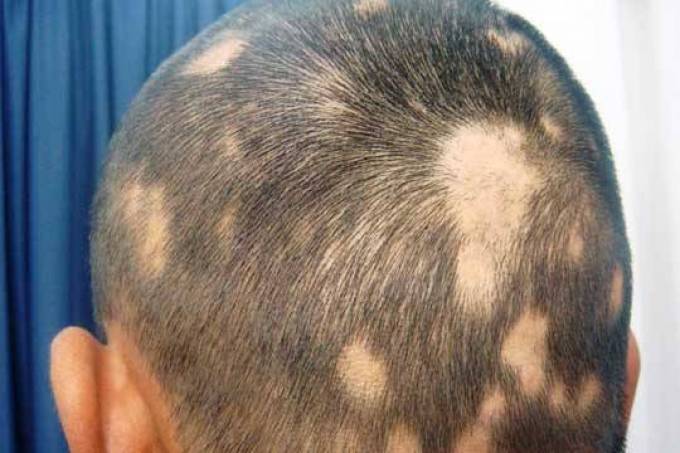 Does a Trichologist Recommend Scalp Exfoliation?