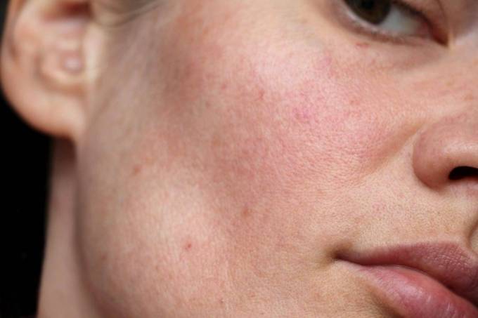 What’s the Fastest Way to Treat Large Pores?