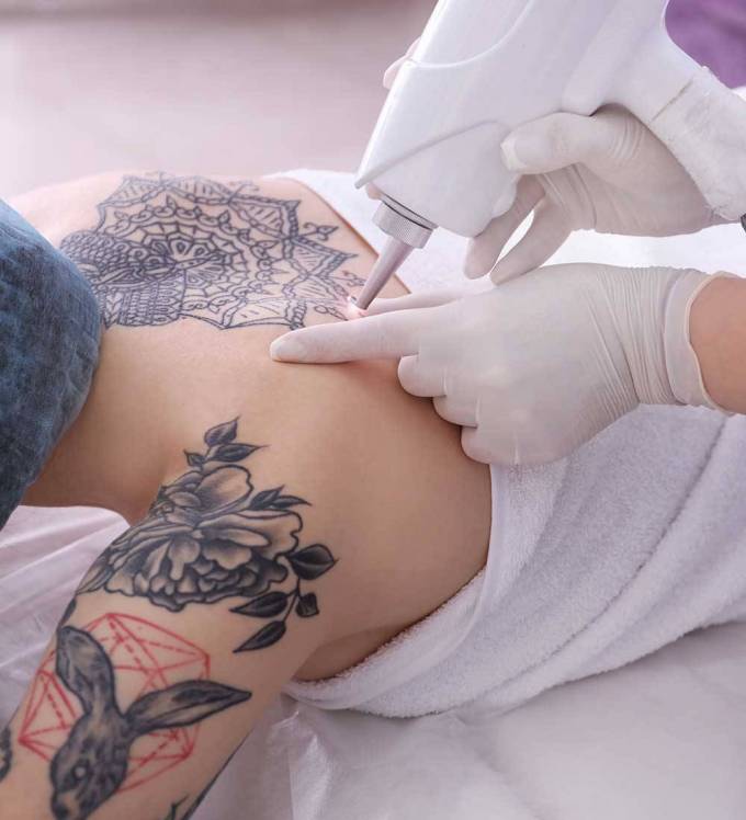 Is Laser Tattoo Removal Suitable for Old Ink?