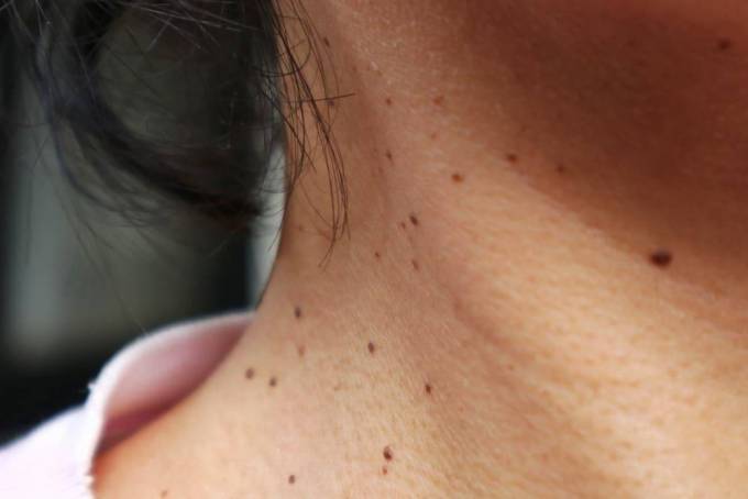 Does Skin Tag Removal Require Stitches?