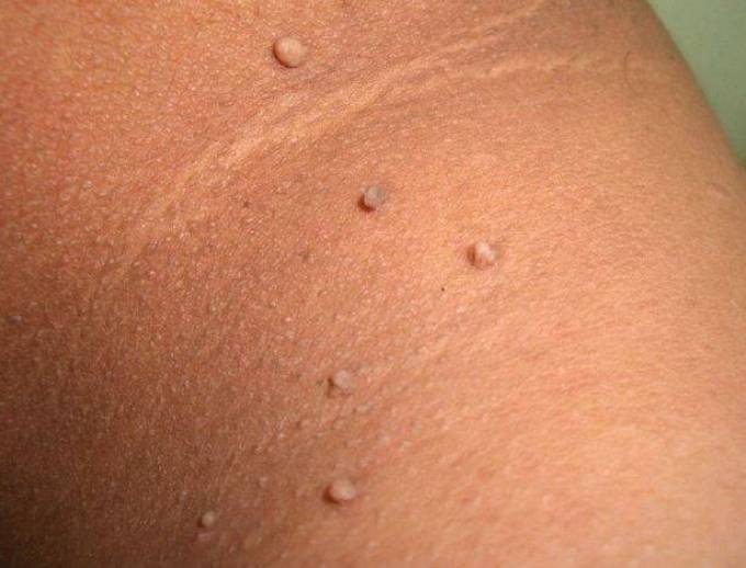 Does Instant Skin Tag Removal Work on Darker Skin Tones?