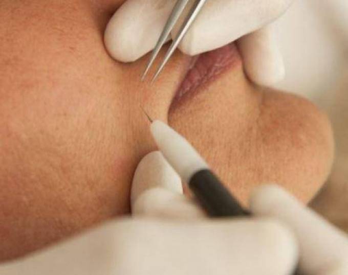 How Many Sessions for Electrolysis Hair Removal?