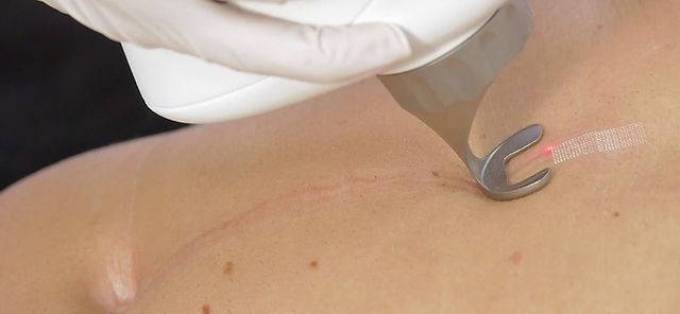 What Skin Conditions Can Laser Scar Removal Improve?