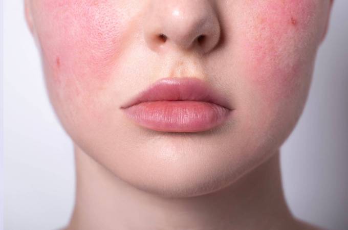 How Can You Soothe Skin While Undergoing Rosacea Treatment?