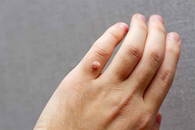 What Are the Common Myths About Warts Removal?