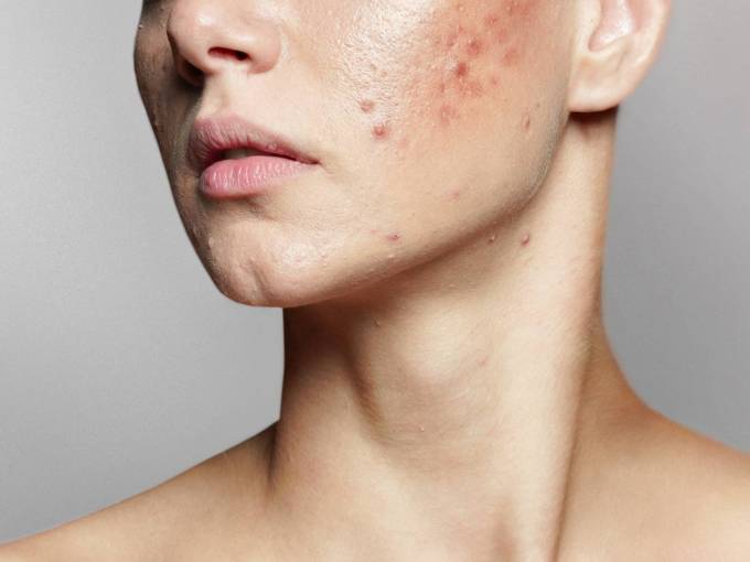 Is There a Non-Invasive Acne Scar Treatment Available?