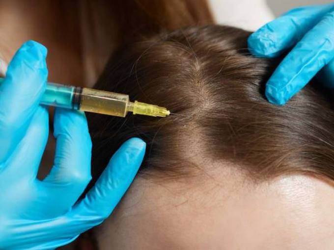 What Is the Best Age for PRP Hair Treatment?
