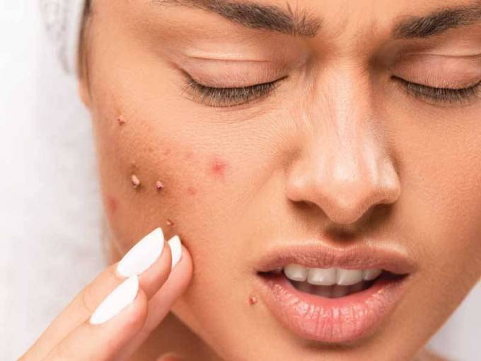 How Does Acne Treatment Work for Sensitive Skin?