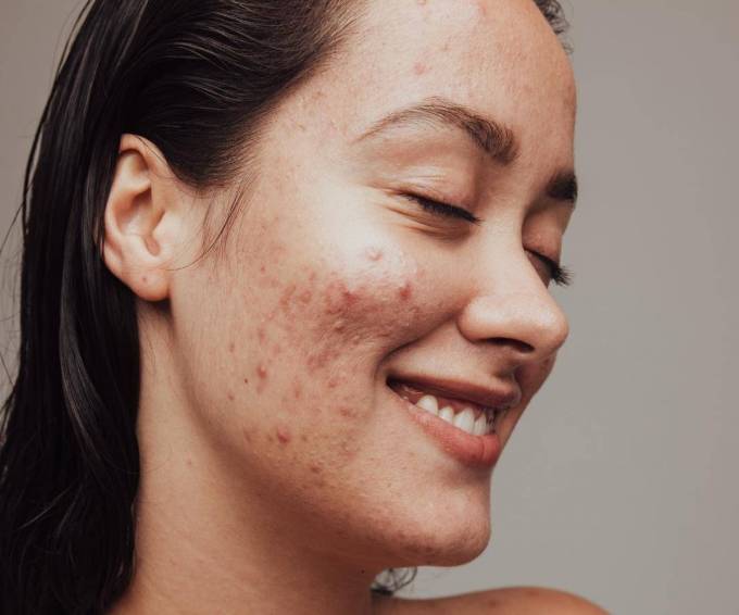 Is Acne Treatment Different for Men and Women?
