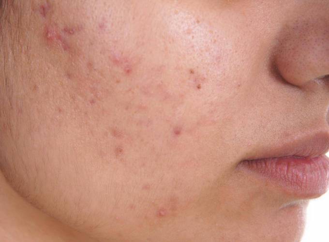 Is Acne Treatment More Difficult During Puberty?