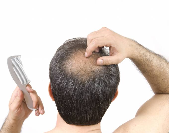 How Hair Loss Treatment Differs by Hair Type