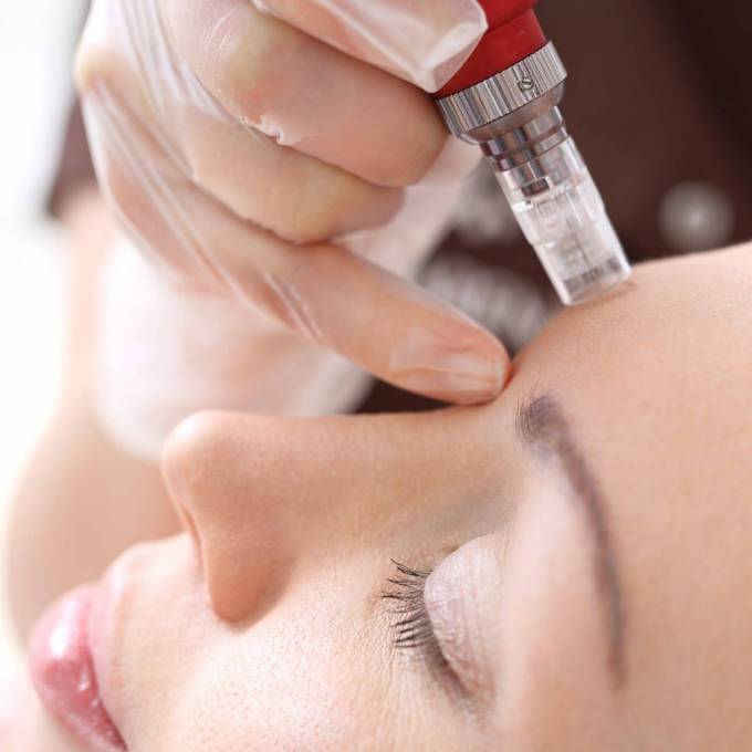 How Does Dermapen Treatment Enhance Skin Renewal?